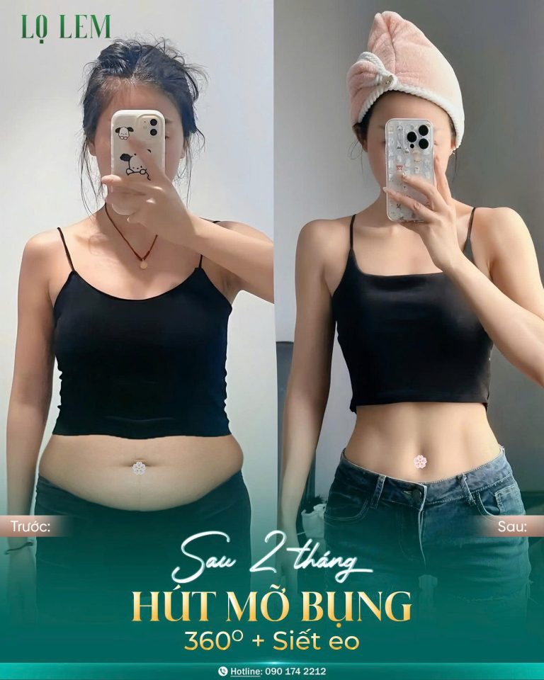 khách hàng hút mỡ tại Lọ Lem sau 2 tháng