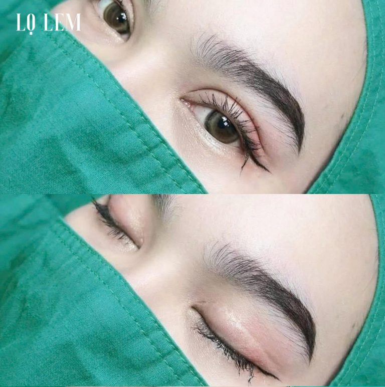 Top 7 địa chỉ cắt mí uy tín tại TP.HCM