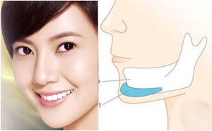 Bảng Giá Độn Cằm Tại 7 Cơ Sở Uy Tín Tp.hcm