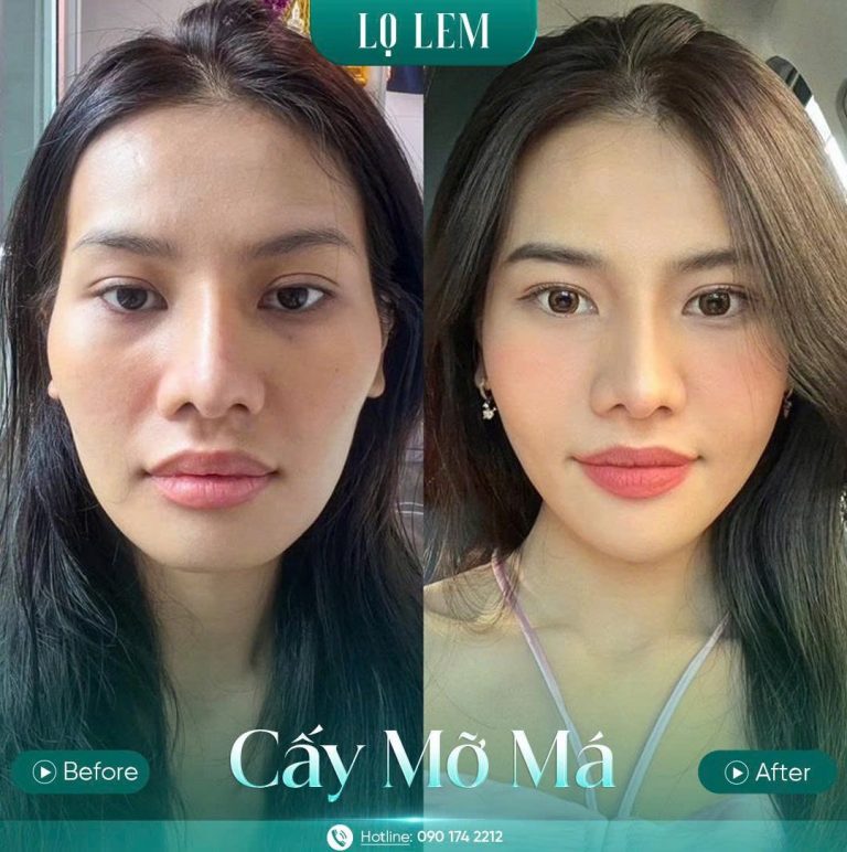 Kết quả của khách hàng sau khi cấy mỡ mặt Baby tại Lọ Lem Kết quả của khách hàng sau khi cấy mỡ mặt Baby tại Lọ Lem