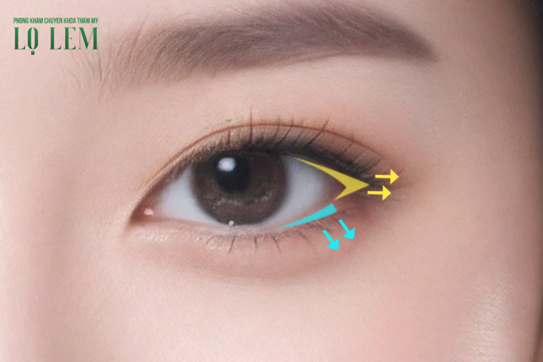 Mở Góc Mắt Bao Nhiêu Tiền Tại Top 7 địa Chỉ Uy Tín Tp. Hcm Mở Góc Mắt Bao Nhiêu Tiền Tại Top 7 địa Chỉ Uy Tín Tp. Hcm