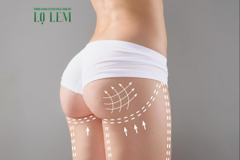 Cấy mỡ mông tự thân hay nâng mông đặt túi? Top địa chỉ tại Tân Bình Cấy mỡ mông tự thân hay nâng mông đặt túi? Top địa chỉ tại Tân Bình