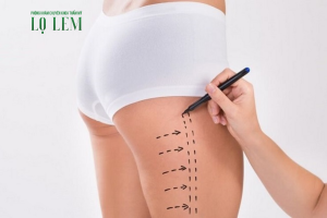 Hút Mỡ Đùi Bao Nhiêu Tiền? Top 7 Địa Chỉ Uy Tín Tại Tp. Hcm