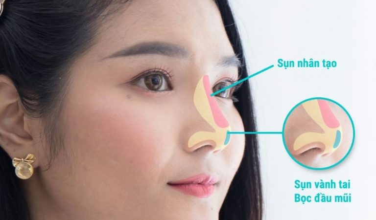 Nâng Mũi Bọc Sụn Tai Có Bền Không? Địa Chỉ Uy Tín Tại Tân Bình Nâng Mũi Bọc Sụn Tai Có Bền Không? Địa Chỉ Uy Tín Tại Tân Bình