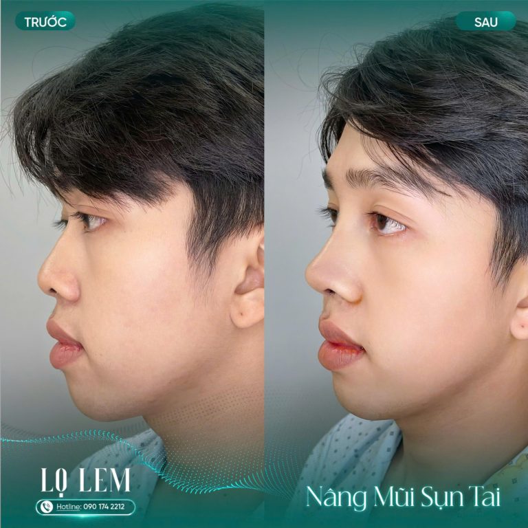 Nâng Mũi Bọc Sụn Tai Có Bền Không? Địa Chỉ Uy Tín Tại Tân Bình Nâng Mũi Bọc Sụn Tai Có Bền Không? Địa Chỉ Uy Tín Tại Tân Bình
