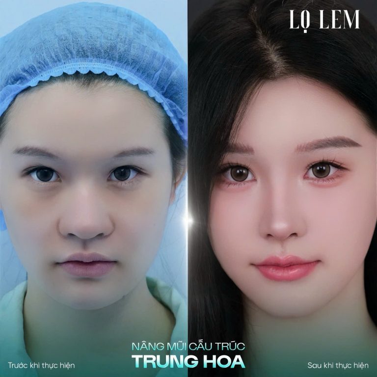 Nâng Mũi Cấu Trúc Trung Hoa Là Gì? Xu Hướng Mũi Hot Trend 2026 Nâng Mũi Cấu Trúc Trung Hoa Là Gì? Xu Hướng Mũi Hot Trend 2026