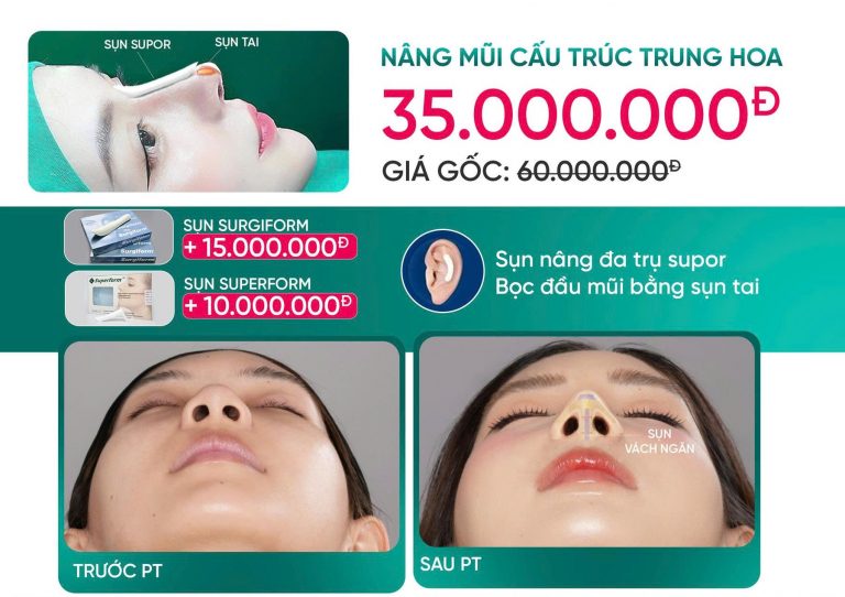 Nâng Mũi Cấu Trúc Trung Hoa Là Gì? Xu Hướng Mũi Hot Trend 2026 Nâng Mũi Cấu Trúc Trung Hoa Là Gì? Xu Hướng Mũi Hot Trend 2026