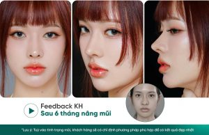 Hình ảnh khách hàng trước và sau khi nâng mũi tại Lọ Lem