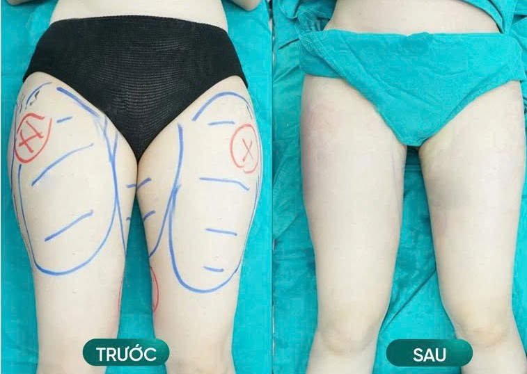 Hình ảnh trước và sau khi hút mỡ đùi của khách hàng tại Lọ Lem Hình ảnh trước và sau khi hút mỡ đùi của khách hàng tại Lọ Lem