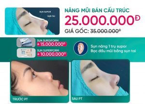 Nâng Mũi Hàn Quốc Giá Bao Nhiêu? Gợi ý địa Chỉ Uy Tín Tại Tân Bình