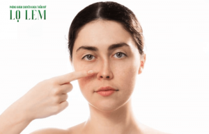 Sụp sụn mũi phải làm sao? Cách khắc phục an toàn và hiệu quả