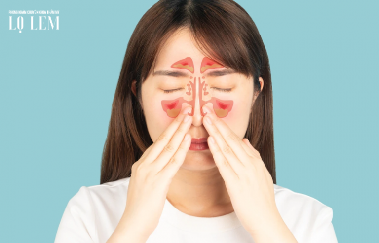 Bị viêm xoang có nâng mũi được không? Khi nào nên làm? Bị viêm xoang có nâng mũi được không? Khi nào nên làm?