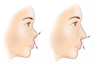 Lỗ mũi hở là tốt hay xấu? Có nên phẩu thuật chỉnh sửa mũi không?