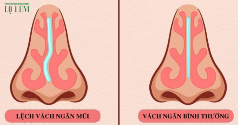 Cách Nhận Biết Mũi Bị Lệch? Địa Chỉ Sửa Mũi Tại Tân Bình Cách Nhận Biết Mũi Bị Lệch? Địa Chỉ Sửa Mũi Tại Tân Bình